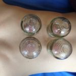 Geelong Chinese Medicine Centre - Cupping